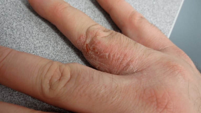 Riconoscere la dermatite (eczema) da freddo e curarla